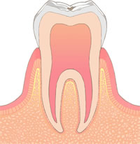 CO（初期虫歯）