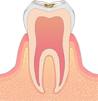 C1（エナメル質までのむし歯）