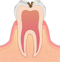 C2（象牙質までのむし歯）