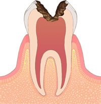 C3（歯髄までのむし歯）