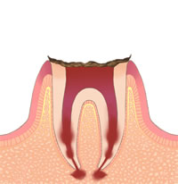C4（歯冠部がほとんど残っていない末期のむし歯）